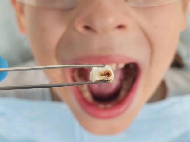 Best Emergency Treatment for Toothache in Random Lake, WI